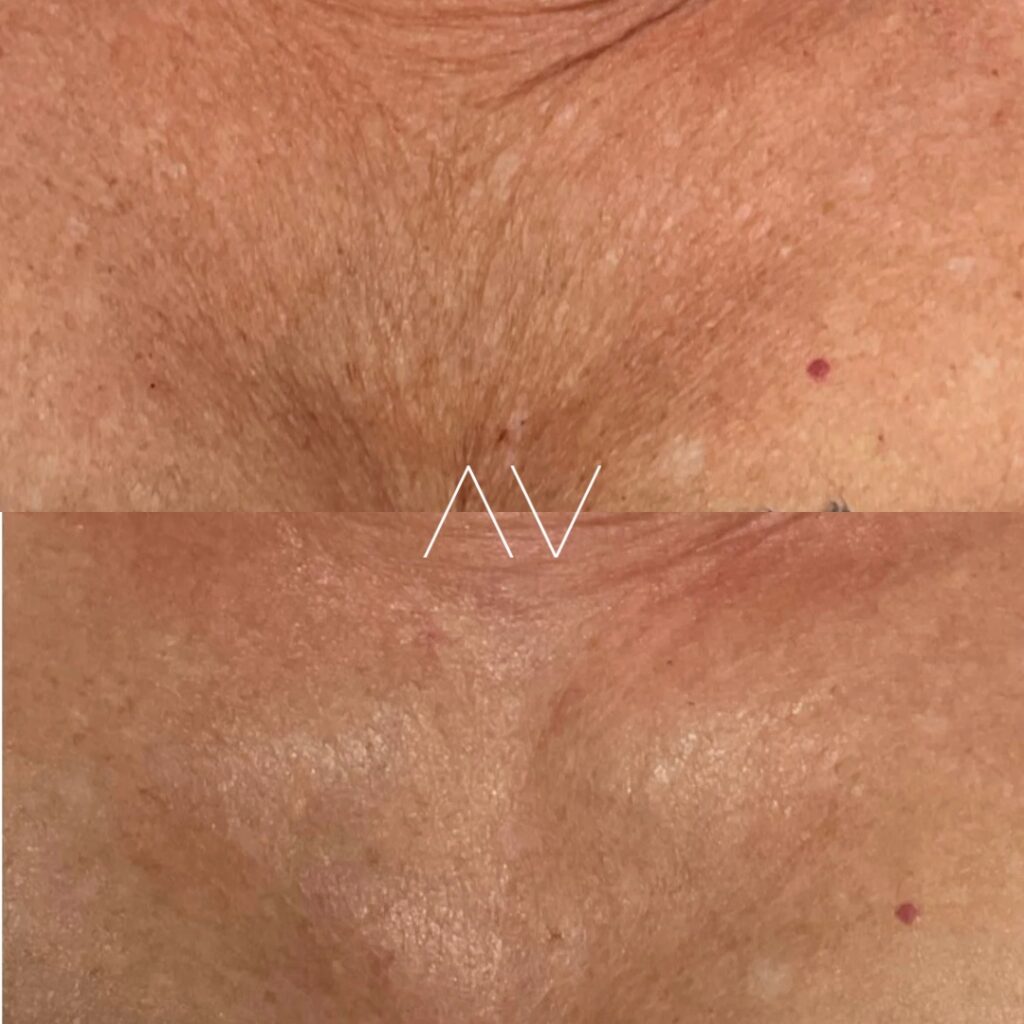 DMK-BeforeAfter