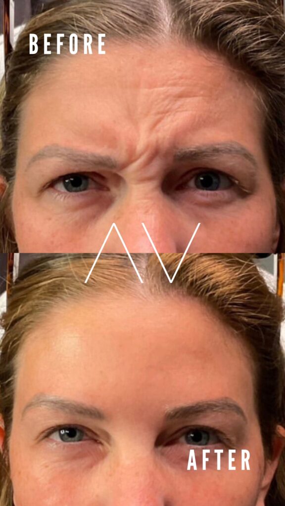 Before-and-After-Dysport