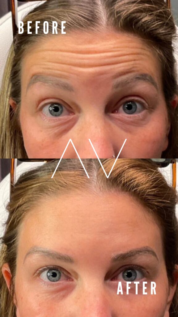 Before-and-After-Dysport