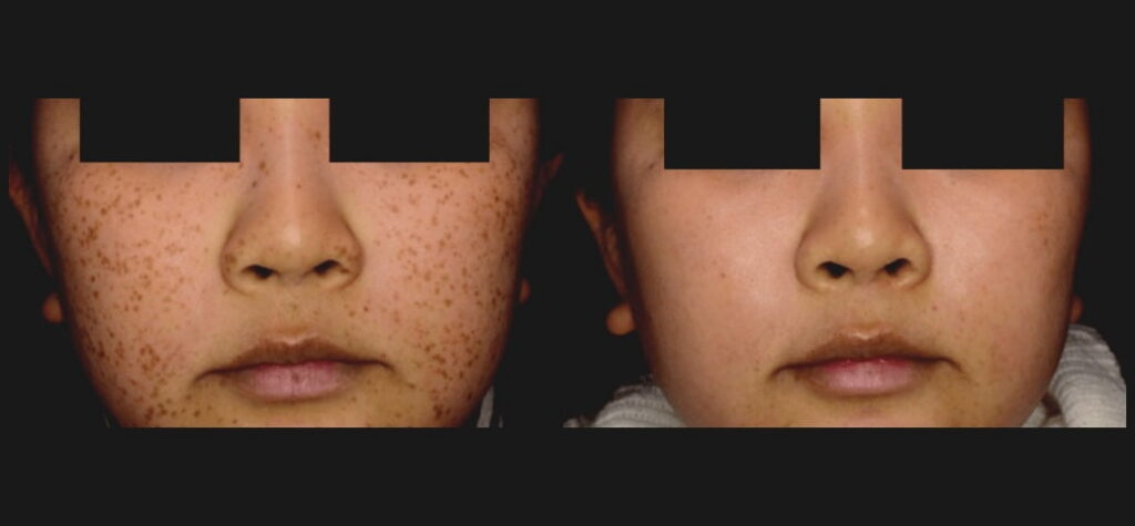 PicoSure-Skin-Revitalization-f