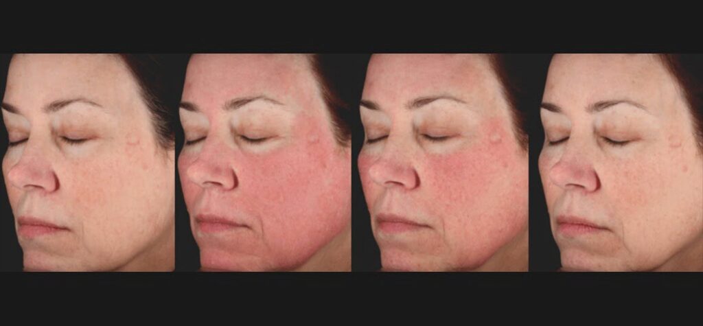 PicoSure®-Skin-Revitalization-j