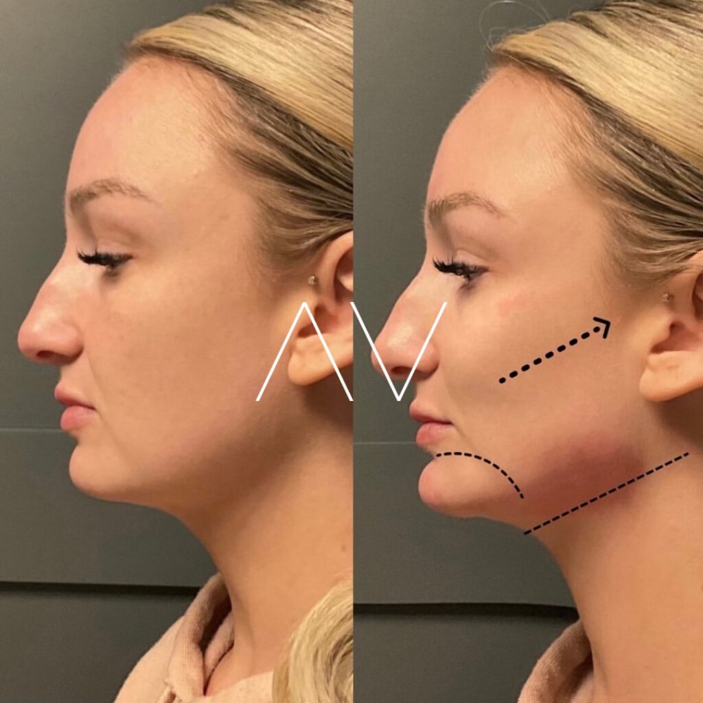 Radiesse-before-and-after