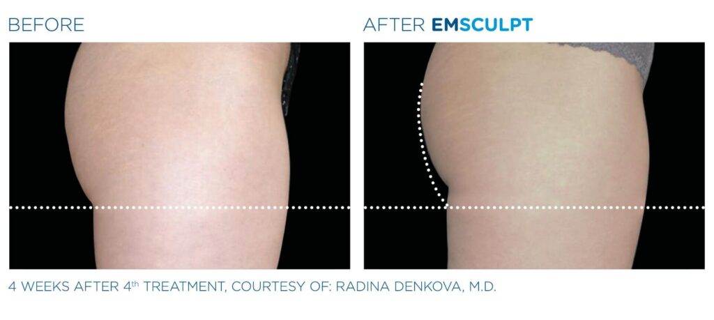 emsculpt-before-and-after-e