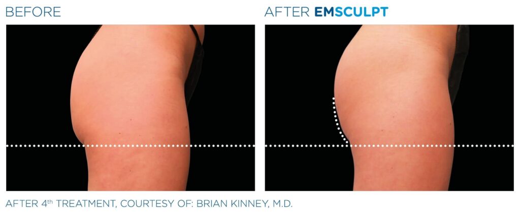 emsculpt-before-and-after-g