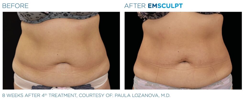 skinney-emsculpt-before-and-after-a