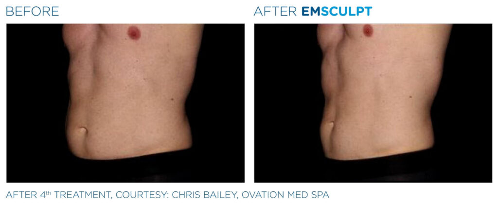 skinney-emsculpt-before-and-after-f