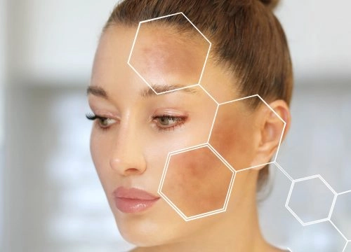 Age-Spots