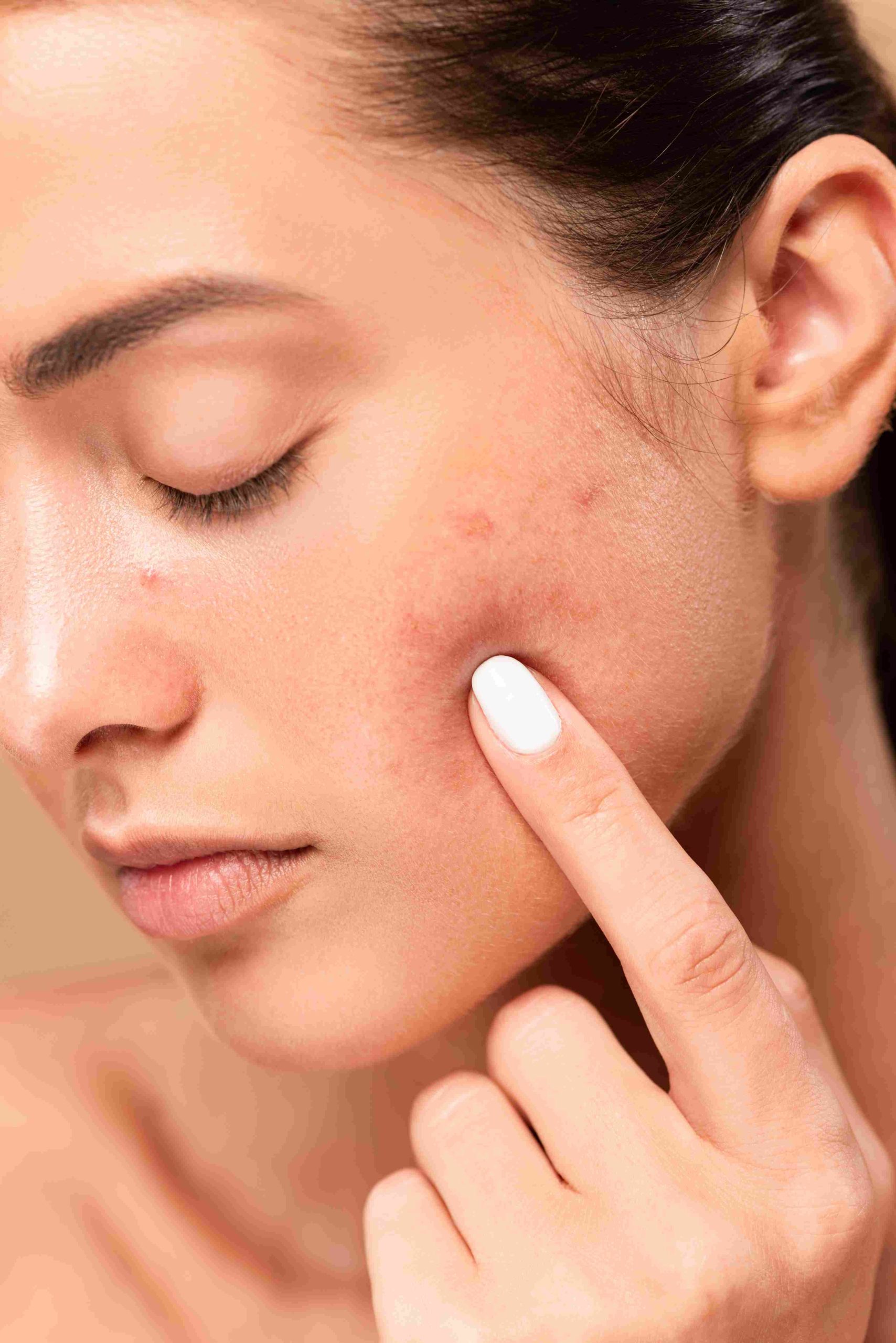 Congested-skin-blemishes-herospace-scaled