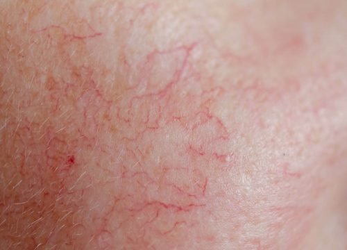Facial-Veins