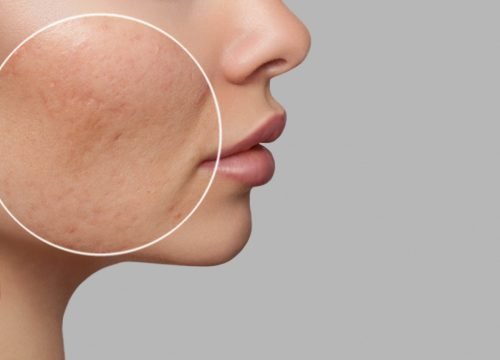Hyperpigmentation