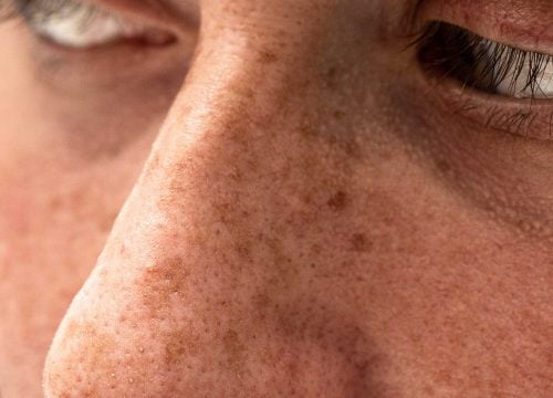 Sun-Damage