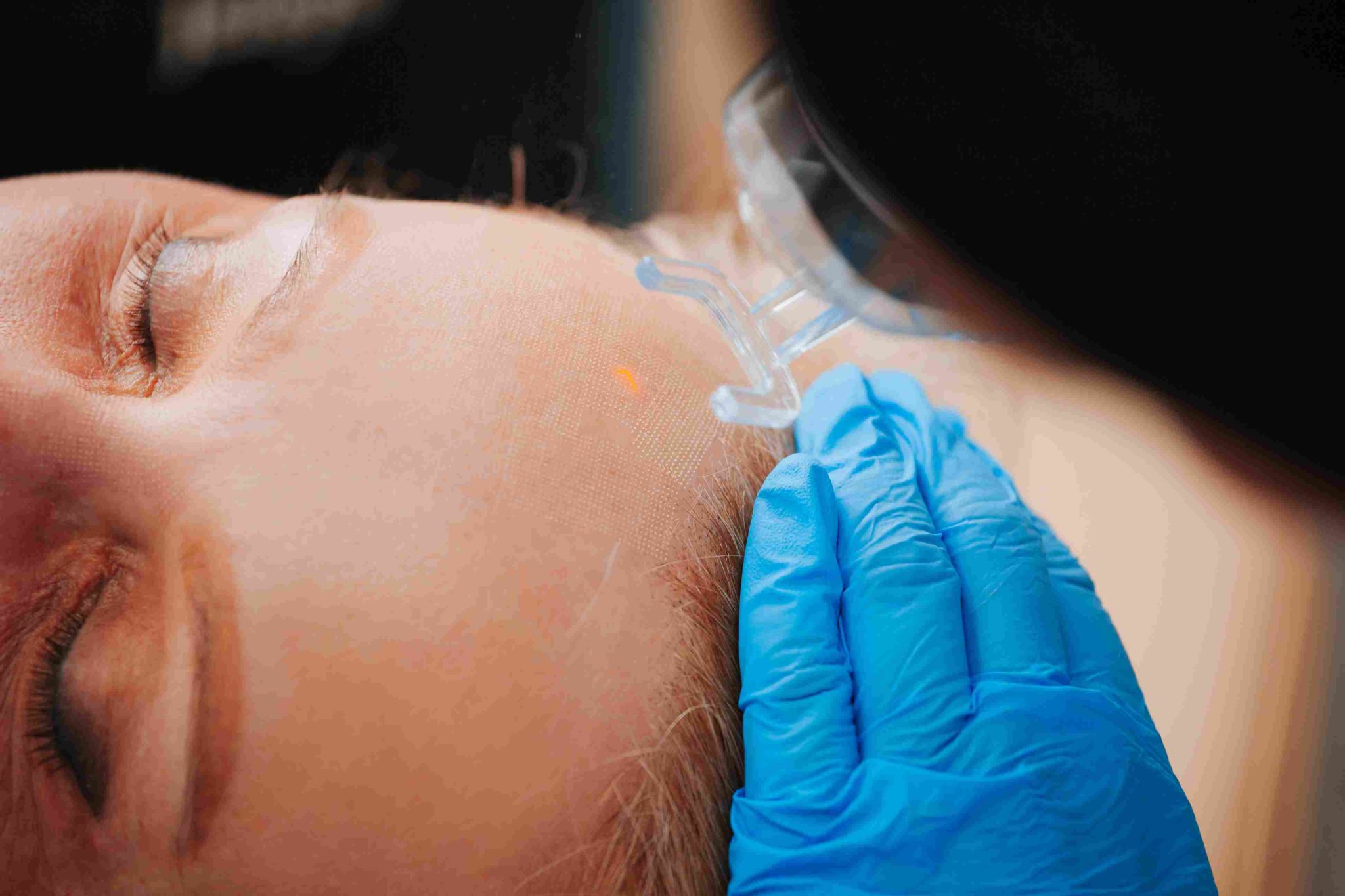 Tetra-co2-coolpeel-avail-aesthetics
